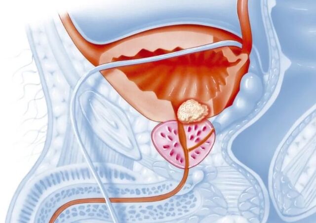 Características da prostatite crônica